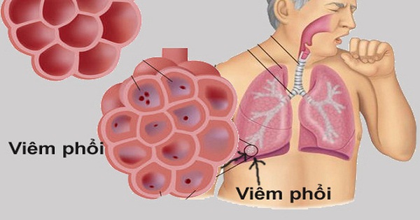 Bộ Y tế khuyến cáo bệnh viêm phổi lạ có nguy cơ xâm nhập vào Việt Nam